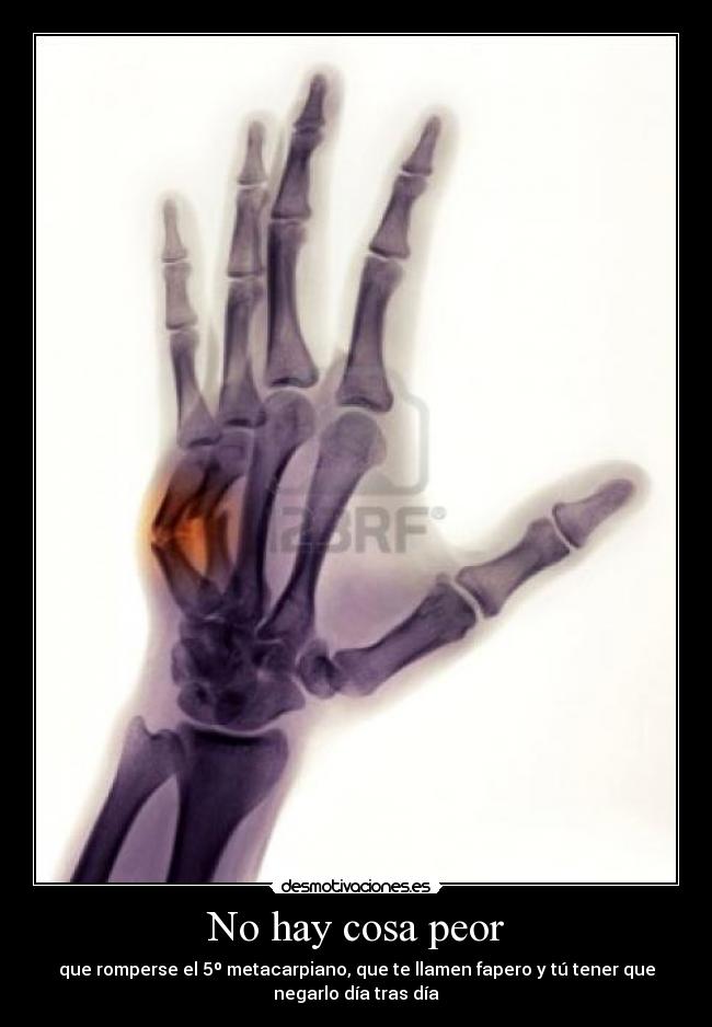 No hay cosa peor - que romperse el 5º metacarpiano, que te llamen fapero y tú tener que
negarlo día tras día