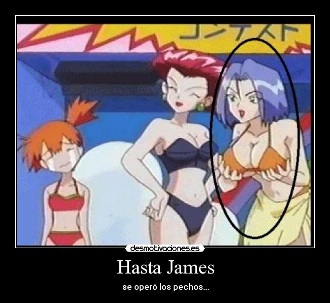 Hasta James - se operó los pechos...