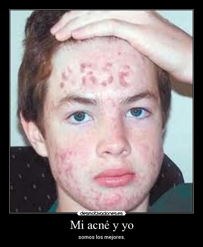 carteles acne desmotivaciones