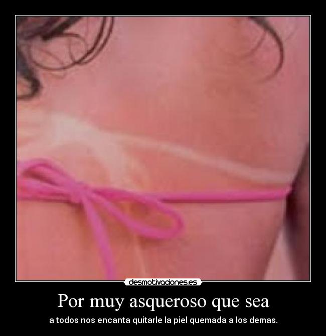 Por muy asqueroso que sea - a todos nos encanta quitarle la piel quemada a los demas.