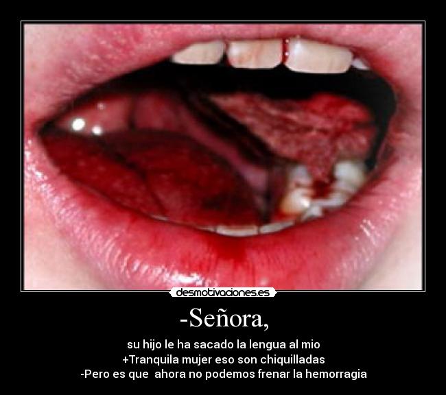 -Señora, - su hijo le ha sacado la lengua al mio
+Tranquila mujer eso son chiquilladas
-Pero es que  ahora no podemos frenar la hemorragia