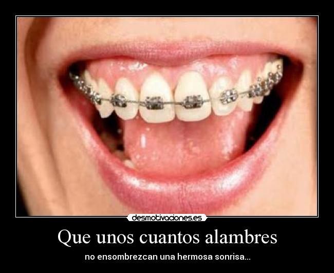 Que unos cuantos alambres - no ensombrezcan una hermosa sonrisa...