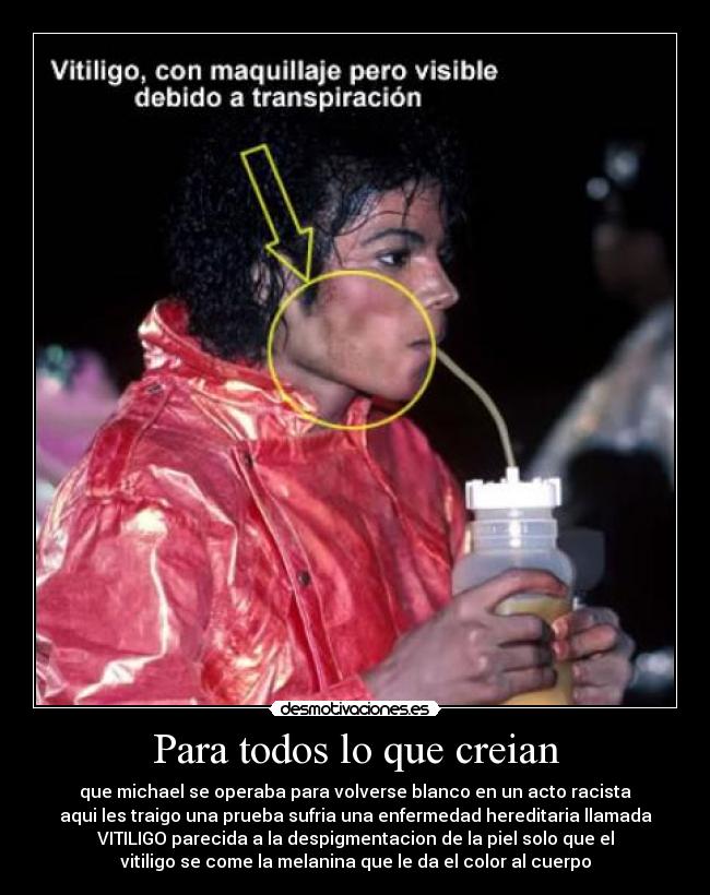 Para todos lo que creian - que michael se operaba para volverse blanco en un acto racista
aqui les traigo una prueba sufria una enfermedad hereditaria llamada
VITILIGO parecida a la despigmentacion de la piel solo que el
vitiligo se come la melanina que le da el color al cuerpo