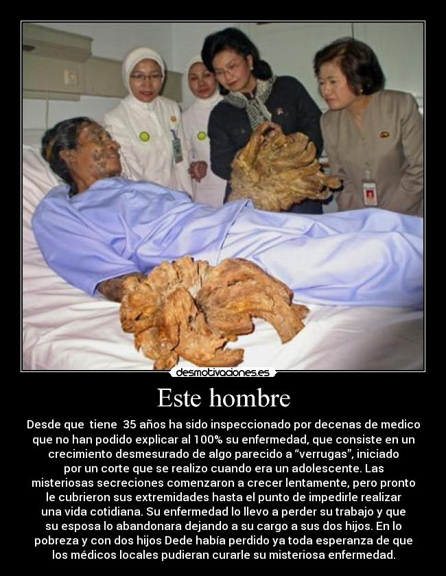 Este hombre - Desde que tiene 35 años ha sido inspeccionado por decenas de medico
que no han podido explicar al 100% su enfermedad, que consiste en un
crecimiento desmesurado de algo parecido a “verrugas”, iniciado
por un corte que se realizo cuando era un adolescente. Las
misteriosas secreciones comenzaron a crecer lentamente, pero pronto
le cubrieron sus extremidades hasta el punto de impedirle realizar
una vida cotidiana. Su enfermedad lo llevo a perder su trabajo y que
su esposa lo abandonara dejando a su cargo a sus dos hijos. En lo
pobreza y con dos hijos Dede había perdido ya toda esperanza de que
los médicos locales pudieran curarle su misteriosa enfermedad.
