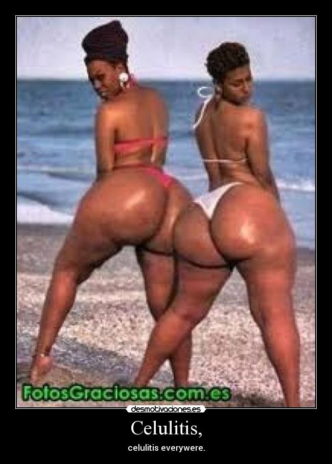 Celulitis, -
