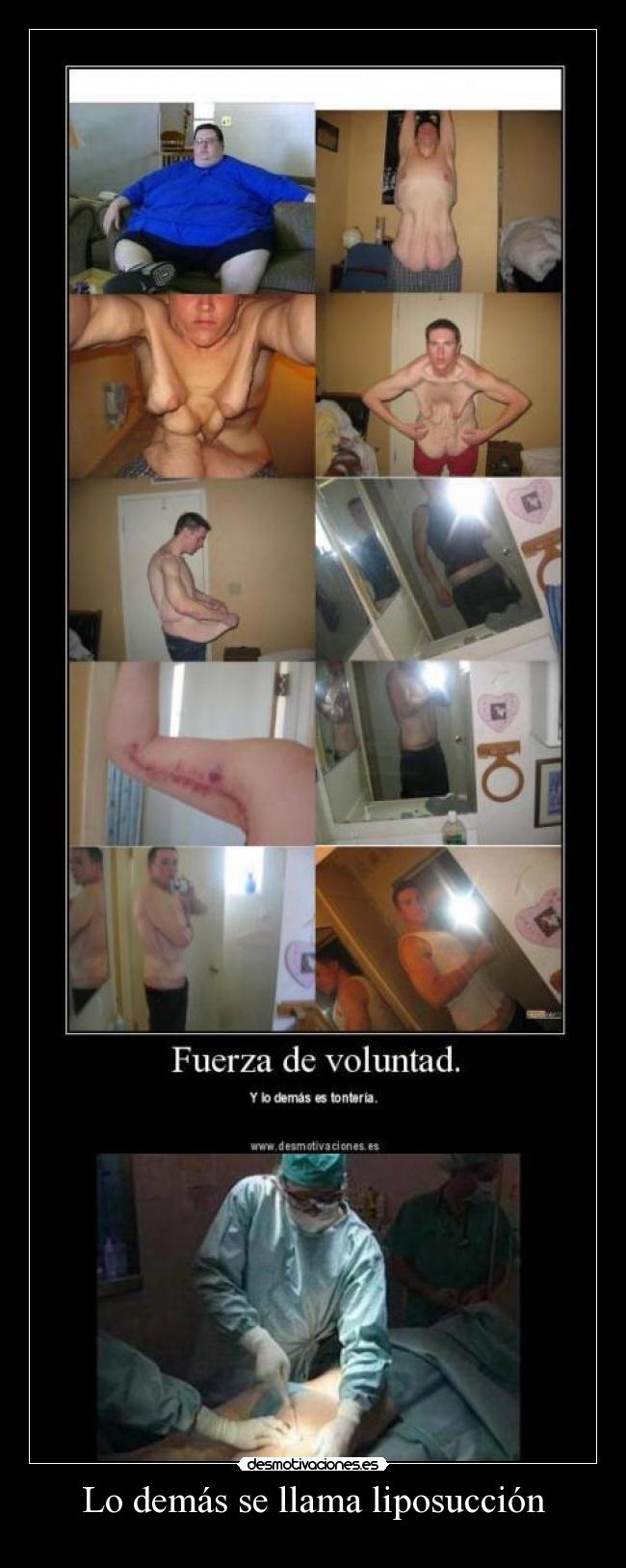 Lo demás se llama liposucción -