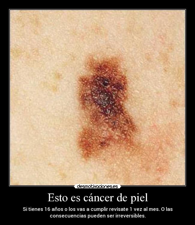 Esto es cáncer de piel -