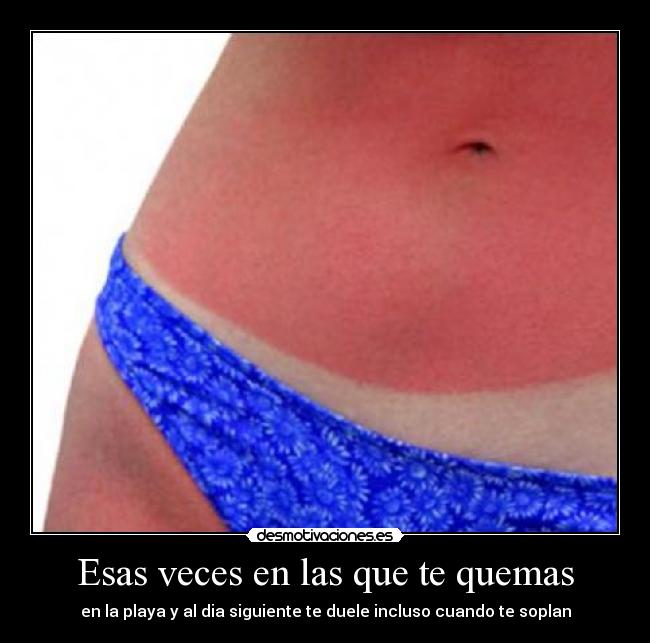 Esas veces en las que te quemas - 