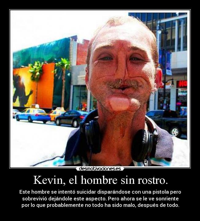 Kevin, el hombre sin rostro. - Este hombre se intentó suicidar disparándose con una pistola pero
sobrevivió dejándole este aspecto. Pero ahora se le ve sonriente
por lo que probablemente no todo ha sido malo, después de todo.
