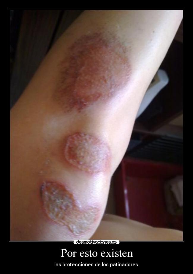 carteles patinar heridas desmotivaciones