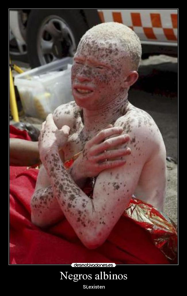 Negros albinos - 