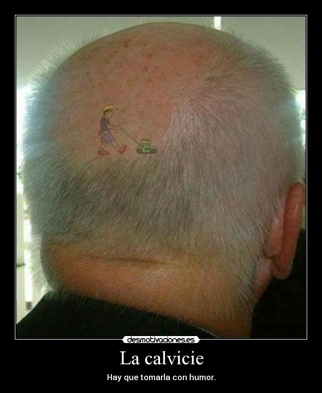 La calvicie -
