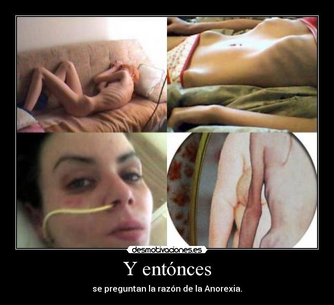 Y entónces - se preguntan la razón de la Anorexia.