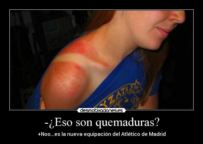 -¿Eso son quemaduras? - 
