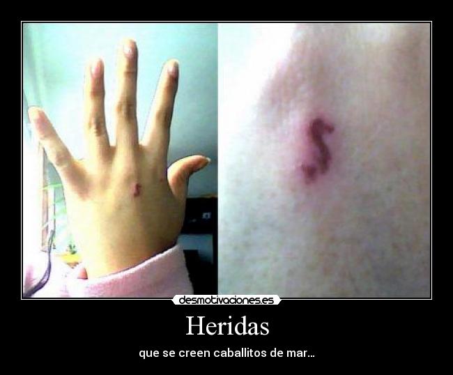 Heridas - que se creen caballitos de mar…