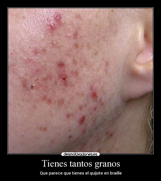 Tienes tantos granos - 