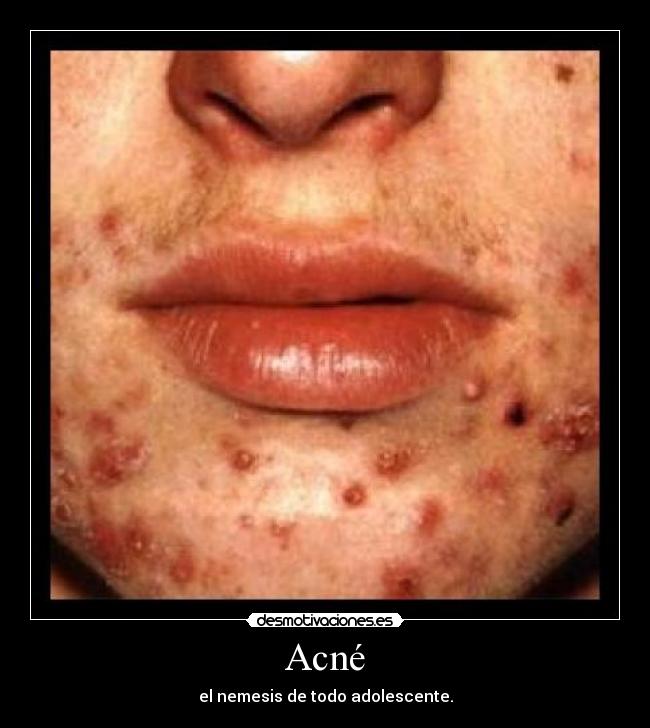 Acné -