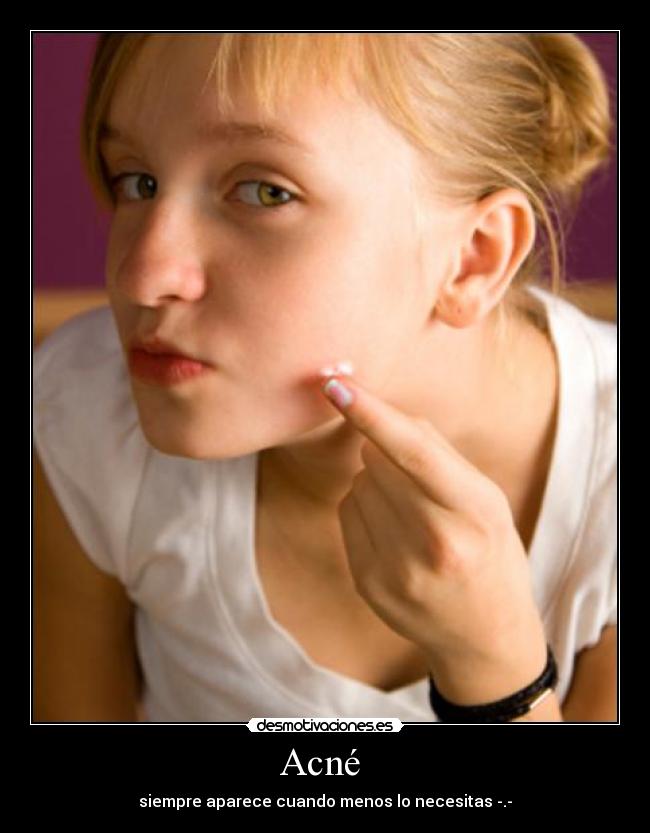 Acné  - 