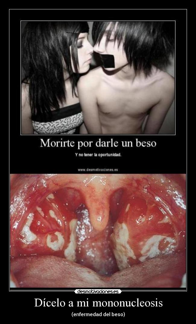 Dícelo a mi mononucleosis - (enfermedad del beso)