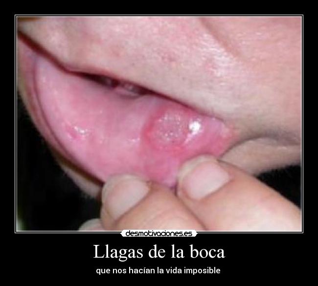 Llagas de la boca -