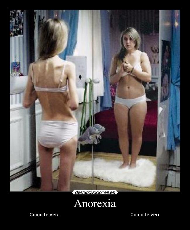 Anorexia - 