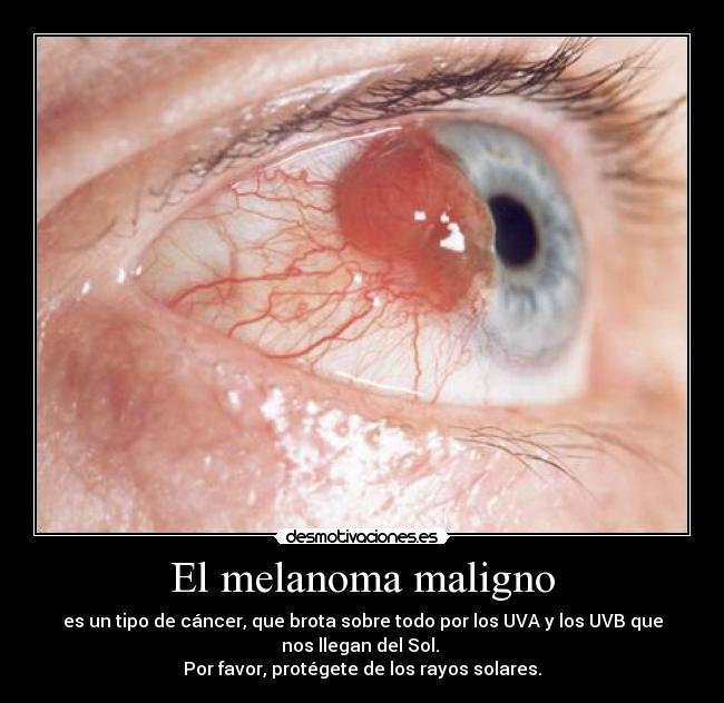 El melanoma maligno - 