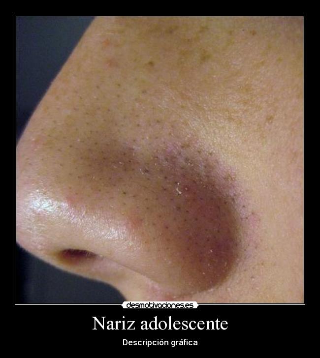 Nariz adolescente - Descripción gráfica