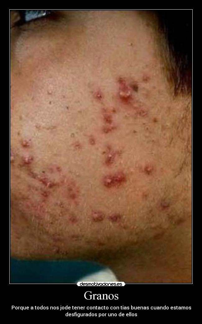 Granos - Porque a todos nos jode tener contacto con tias buenas cuando estamos
desfigurados por uno de ellos