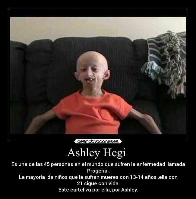 Ashley Hegi  - Es una de las 45 personas en el mundo que sufren la enfermedad llamada Progeria .
La mayoría  de niños que la sufren mueres con 13-14 años ,ella con 21 sigue con vida.
Este cartel va por ella, por Ashley.