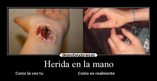 Herida en la mano -