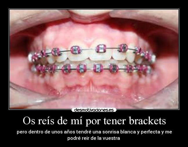 Os reís de mí por tener brackets - 