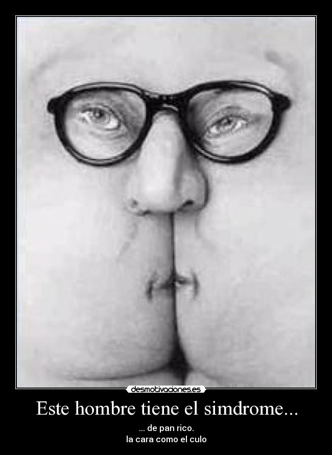 Este hombre tiene el simdrome... - ... de pan rico.
la cara como el culo