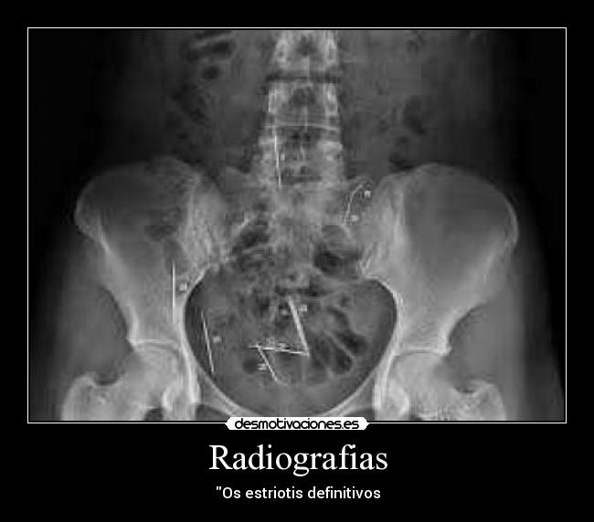 Radiografias - Os estriotis definitivos