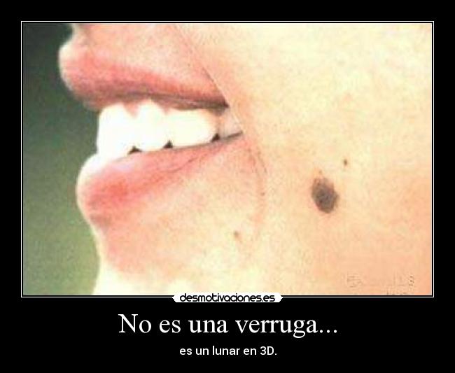 No es una verruga... -