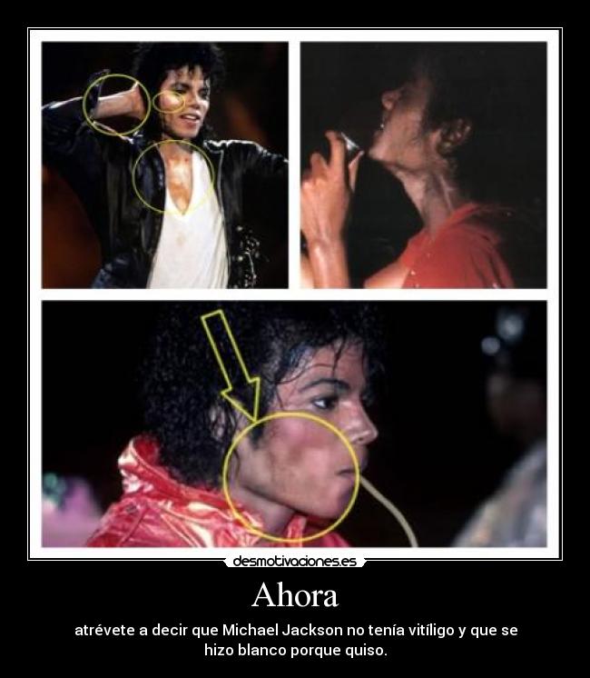 Ahora - atrévete a decir que Michael Jackson no tenía vitíligo y que se
hizo blanco porque quiso.