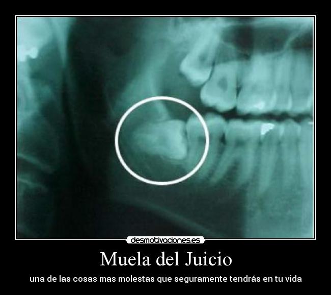 Muela del Juicio - una de las cosas mas molestas que seguramente tendrás en tu vida