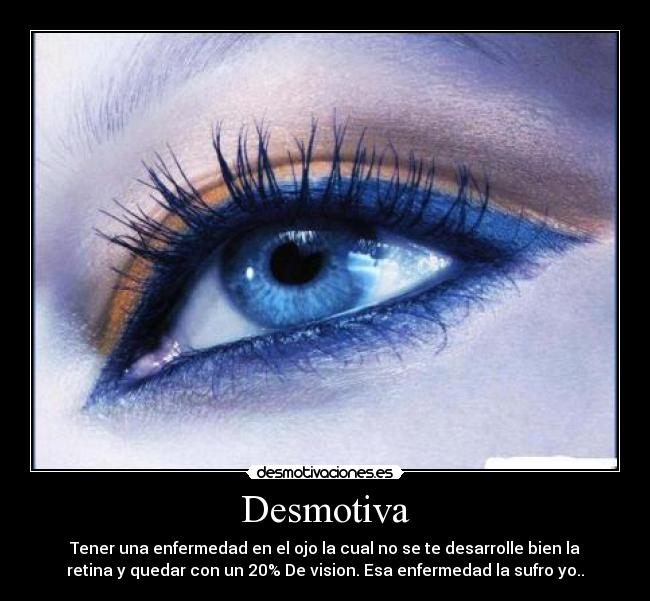 Desmotiva - Tener una enfermedad en el ojo la cual no se te desarrolle bien la
retina y quedar con un 20% De vision. Esa enfermedad la sufro yo..