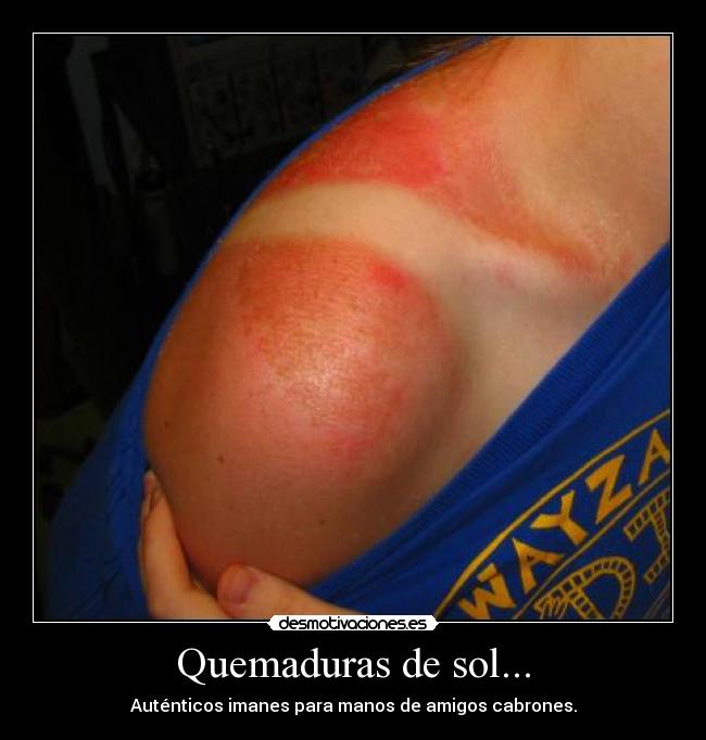 Quemaduras de sol... - 