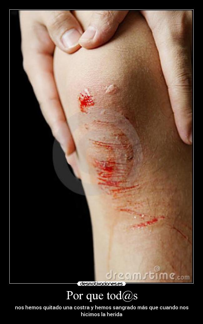 Por que tod@s - nos hemos quitado una costra y hemos sangrado más que cuando nos
hicimos la herida