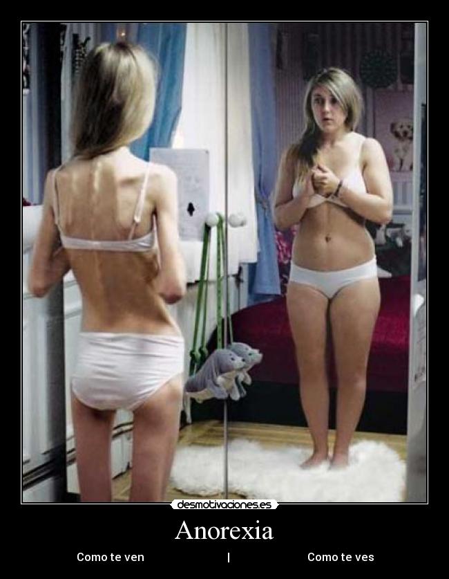 Anorexia -