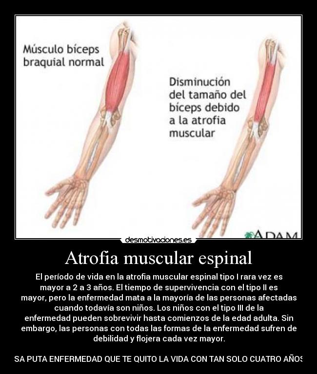 Atrofia muscular espinal - El período de vida en la atrofia muscular espinal tipo I rara vez es
mayor a 2 a 3 años. El tiempo de supervivencia con el tipo II es
mayor, pero la enfermedad mata a la mayoría de las personas afectadas
cuando todavía son niños. Los niños con el tipo III de la
enfermedad pueden sobrevivir hasta comienzos de la edad adulta. Sin
embargo, las personas con todas las formas de la enfermedad sufren de
debilidad y flojera cada vez mayor.

ESA PUTA ENFERMEDAD QUE TE QUITO LA VIDA CON TAN SOLO CUATRO AÑOS. 