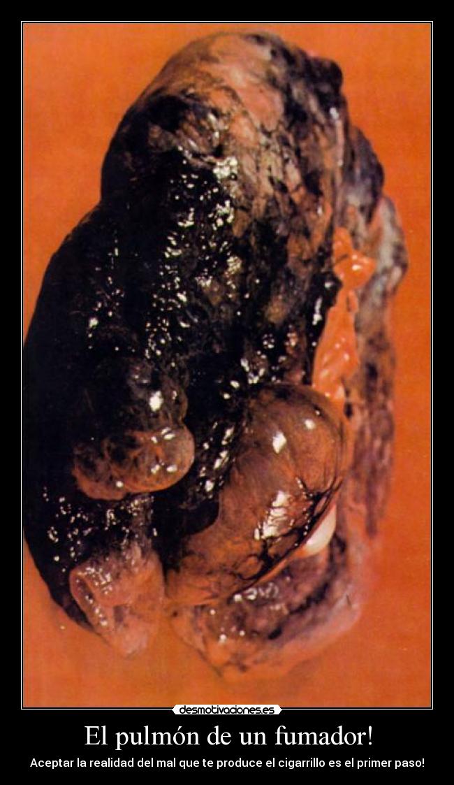 El pulmón de un fumador! - Aceptar la realidad del mal que te produce el cigarrillo es el primer paso!