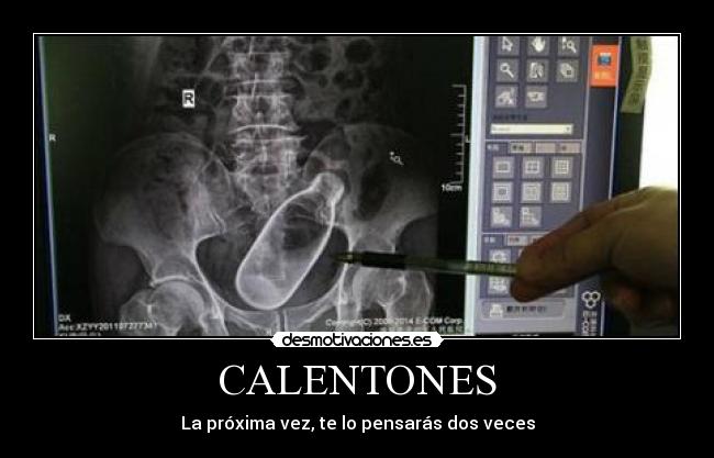 CALENTONES - 