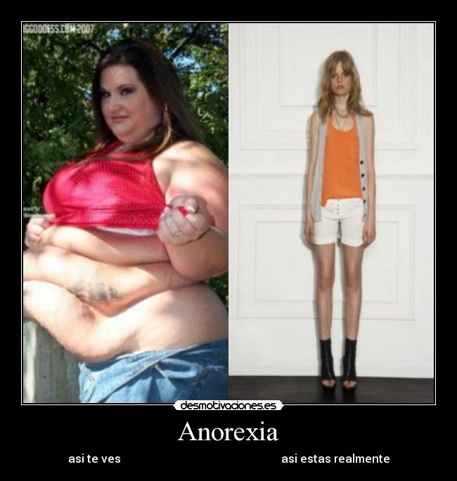 Anorexia -