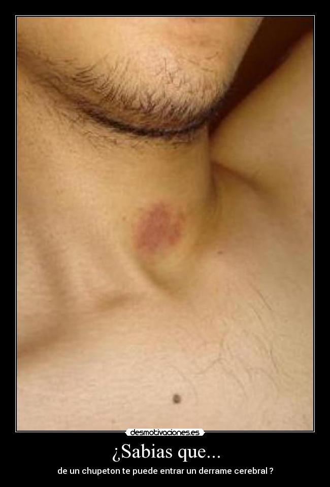 ¿Sabias que... - de un chupeton te puede entrar un derrame cerebral ?