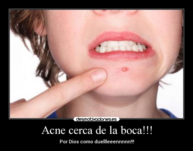 Acne cerca de la boca!!! - 