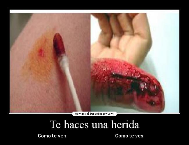 Te haces una herida -