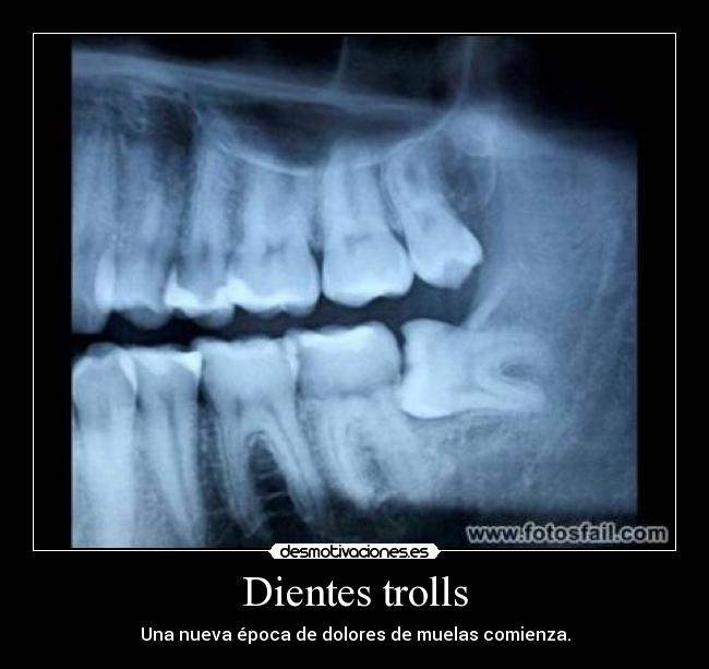 Dientes trolls -