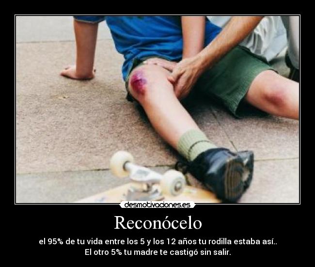 Reconócelo - el 95% de tu vida entre los 5 y los 12 años tu rodilla estaba así..
El otro 5% tu madre te castigó sin salir.