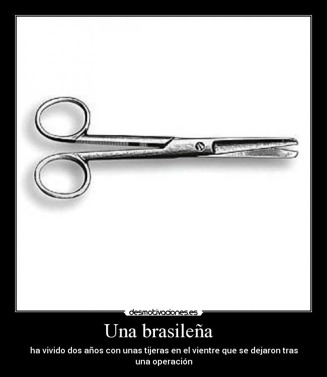Una brasileña - ha vivido dos años con unas tijeras en el vientre que se dejaron tras una operación